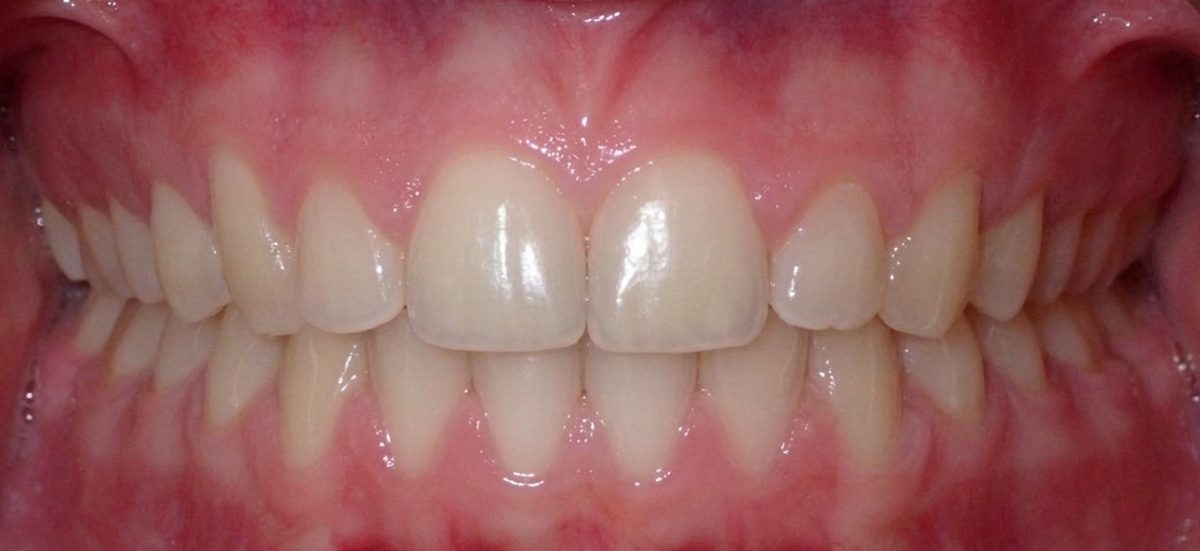 Vivid Smiles patient case 3 before and after treatment comparison after
